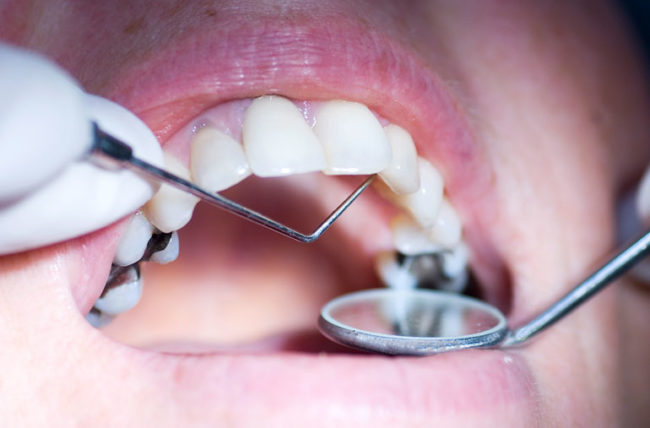 Various pros of dental amalgams